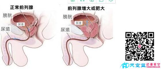 經(jīng)尿道前列腺等離子雙極電切術(shù)動畫視頻d.jpg 經(jīng)尿道前列腺等離子雙極電切術(shù)動畫視頻d.jpg