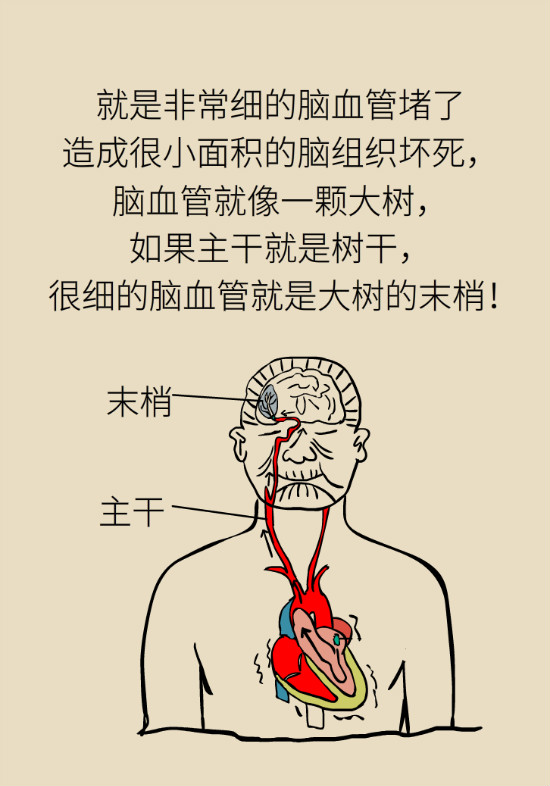腔隙性腦梗死一定是腦血管堵了嗎？