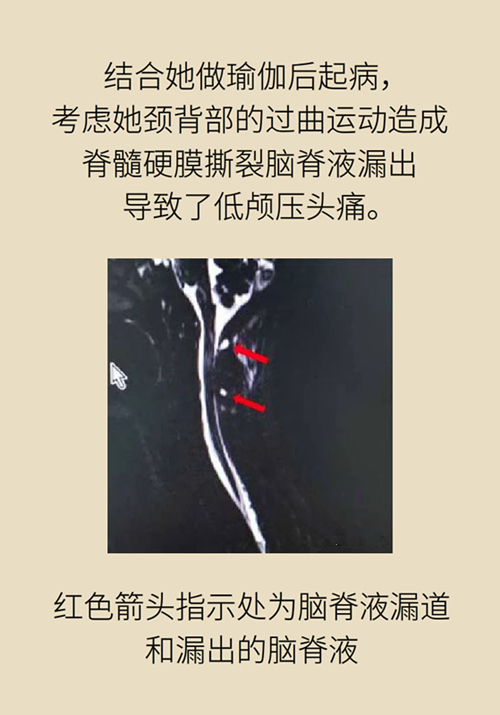 練瑜伽把腦脊液拉漏了！常見的“瑜伽病”你知道多少