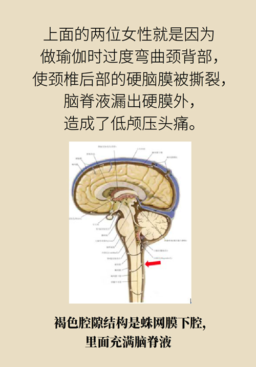 練瑜伽把腦脊液拉漏了！常見的“瑜伽病”你知道多少