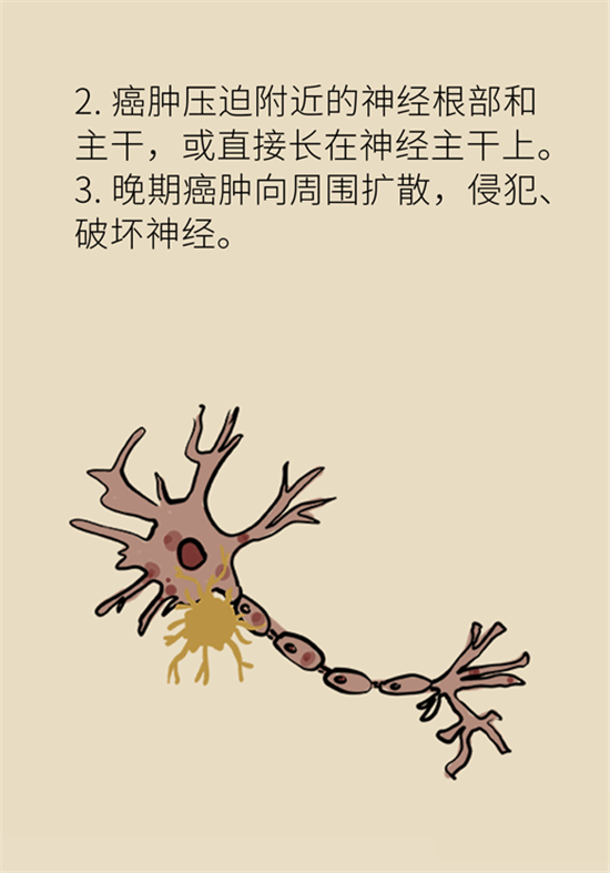 癌癥到底有多痛？需要注意這7個重點問題
