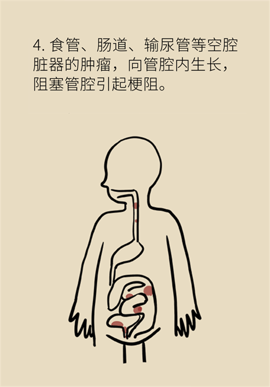 癌癥到底有多痛？需要注意這7個重點問題