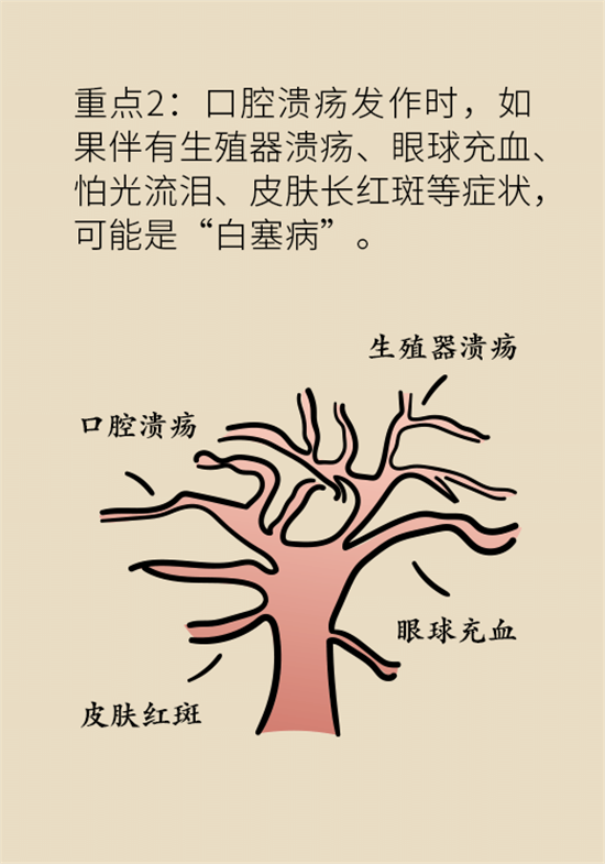 口腔潰瘍還想約火鍋？這四種情況一定要高度警惕