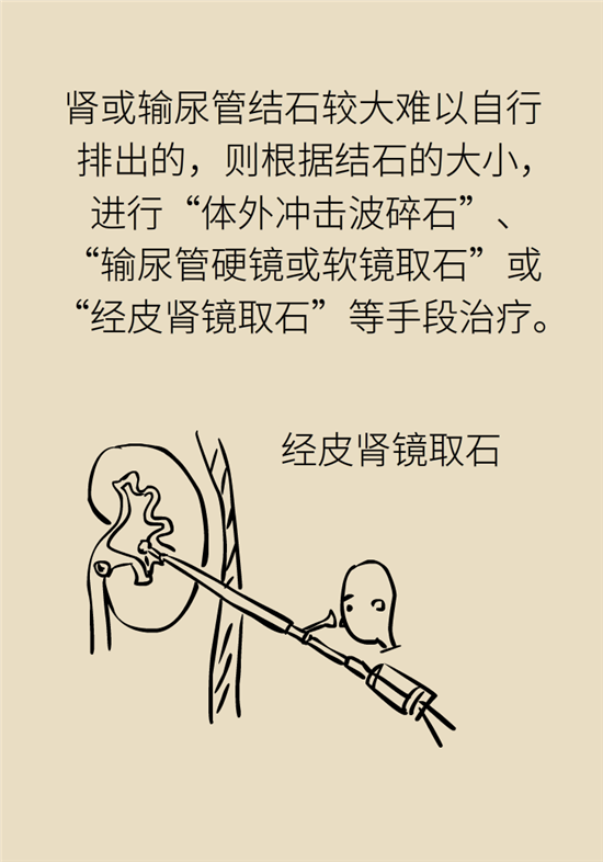 結(jié)石科普：身體里多了各種結(jié)石，應(yīng)該怎么辦？