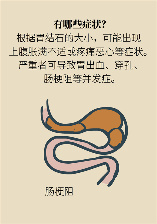 結(jié)石科普：身體里多了各種結(jié)石，應(yīng)該怎么辦？