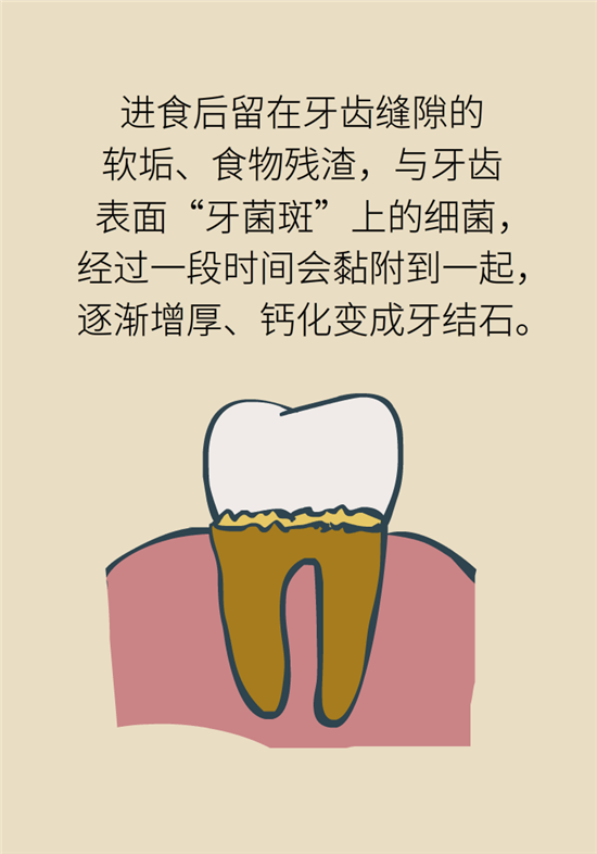 結(jié)石科普：身體里多了各種結(jié)石，應(yīng)該怎么辦？