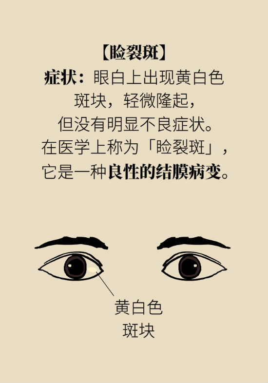 眼白有斑塊、出血要緊嗎？專家：名字唬人但問(wèn)題不大