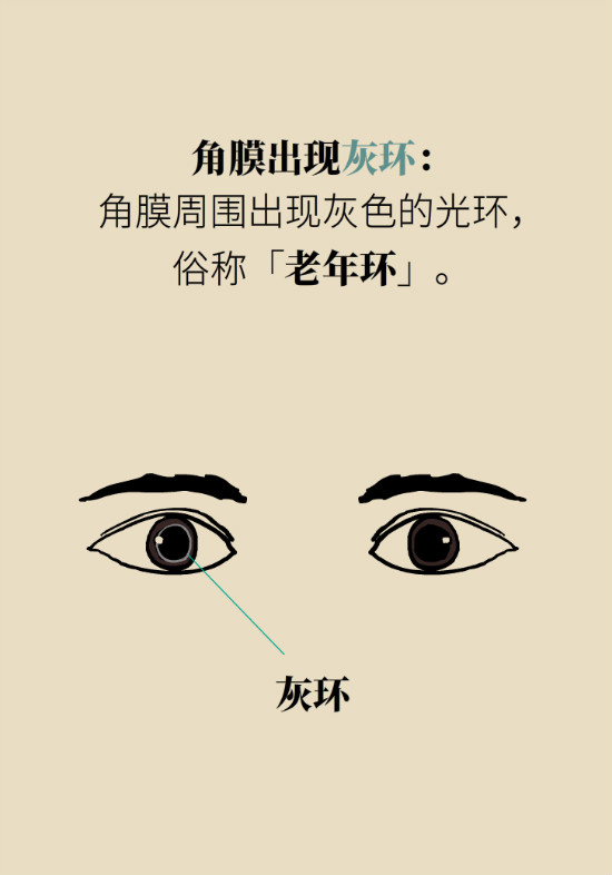 眼白有斑塊、出血要緊嗎？專家：名字唬人但問(wèn)題不大