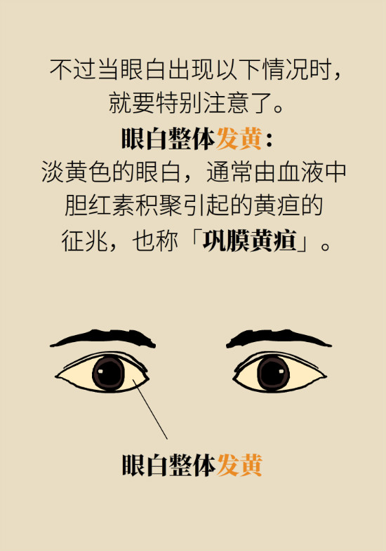 眼白有斑塊、出血要緊嗎？專家：名字唬人但問(wèn)題不大