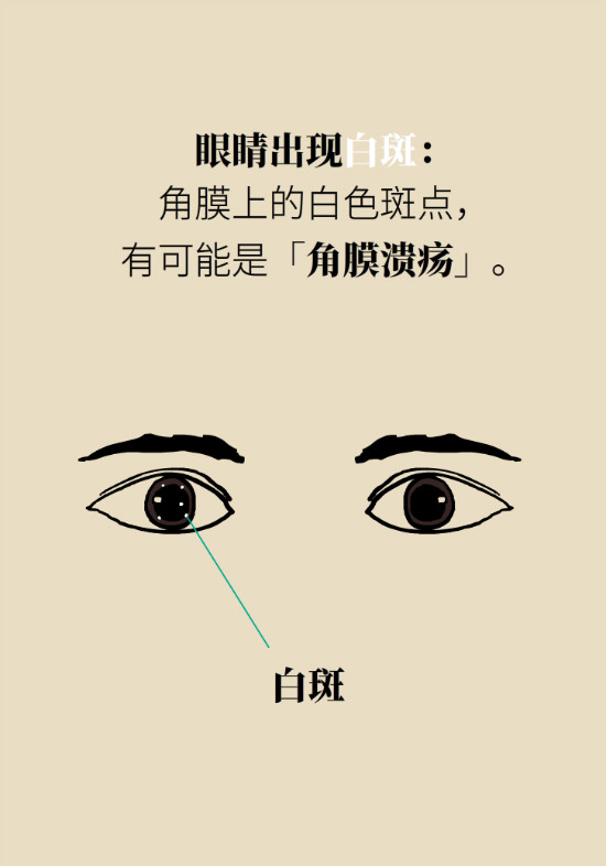 眼白有斑塊、出血要緊嗎？專家：名字唬人但問(wèn)題不大