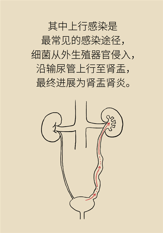 經(jīng)常憋尿會(huì)得急性腎炎？