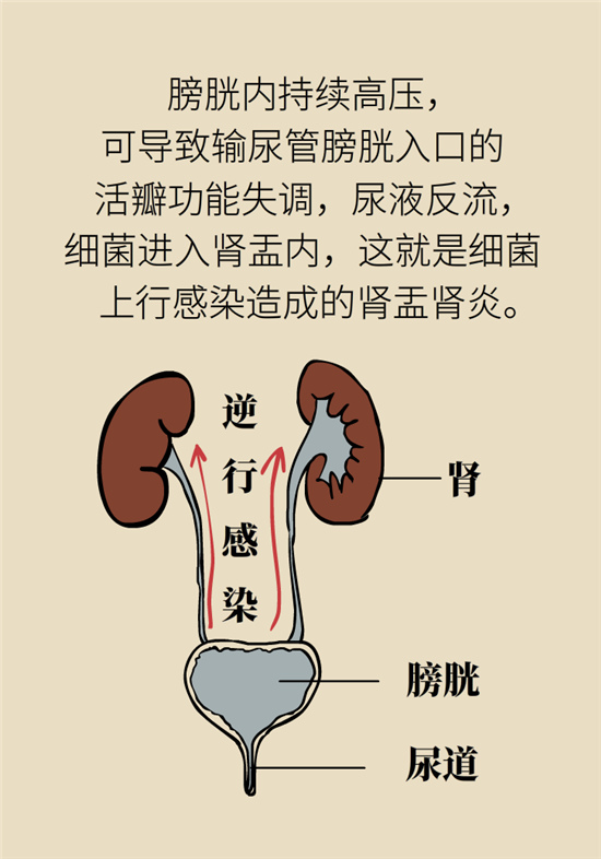 經(jīng)常憋尿會(huì)得急性腎炎？