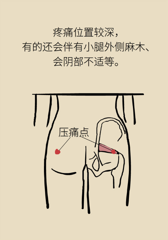 梨狀肌綜合征 梨狀肌綜合征