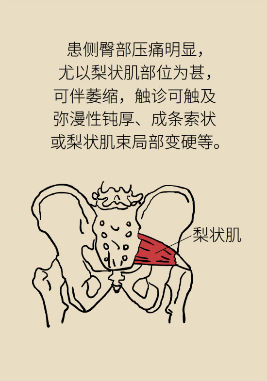 梨狀肌綜合征 梨狀肌綜合征