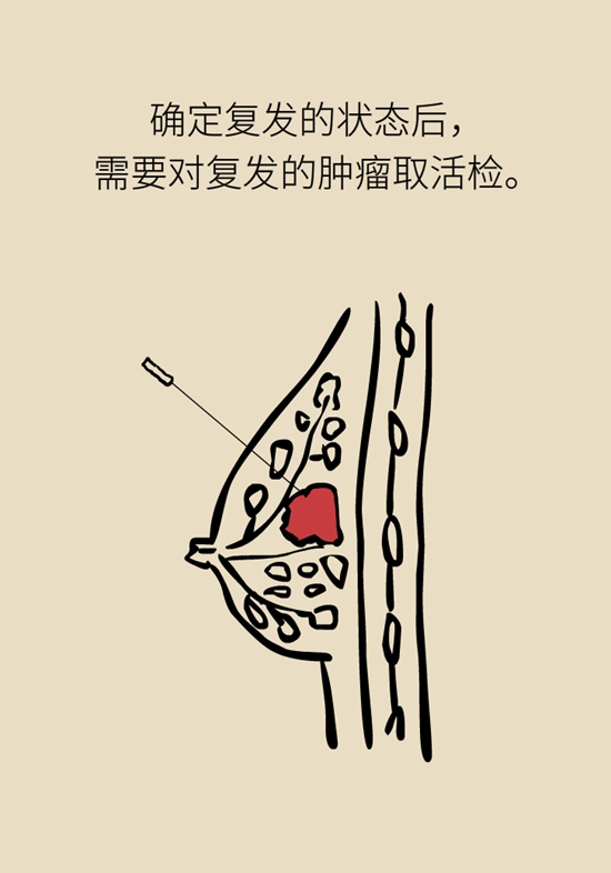乳腺癌復(fù)發(fā)、轉(zhuǎn)移了怎么辦？