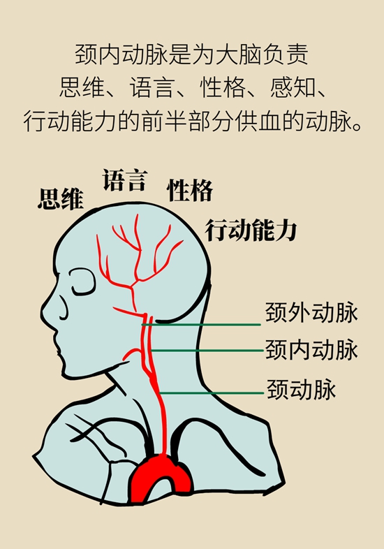 中風