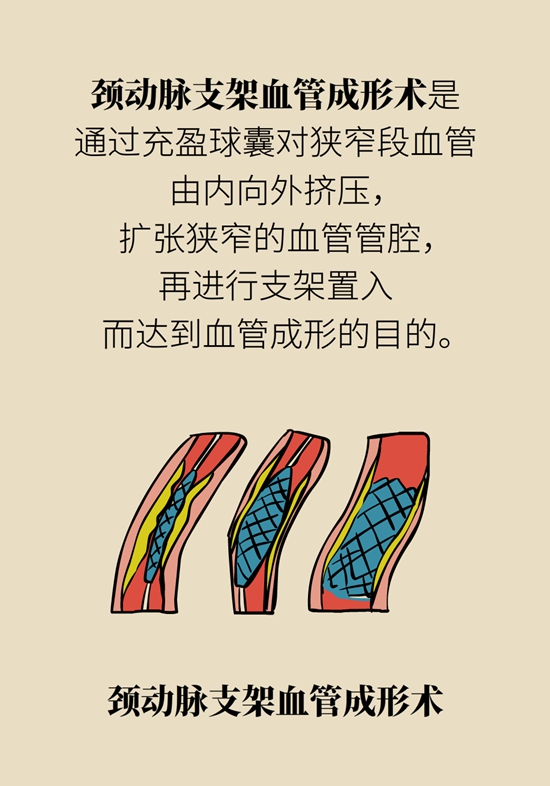 中風
