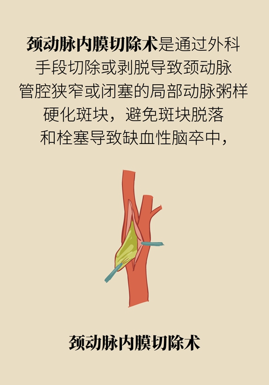 中風