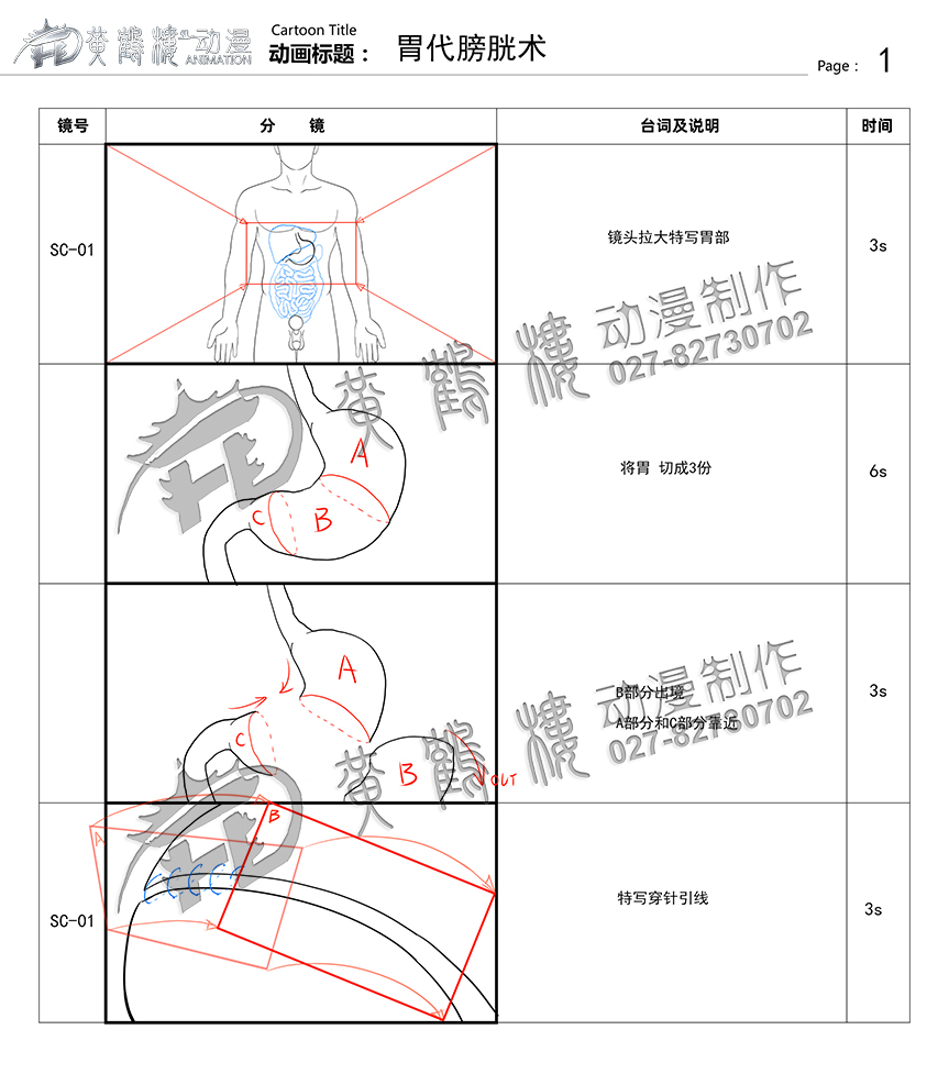 胃代膀胱術(shù)醫(yī)療手術(shù)動(dòng)畫制作.jpg