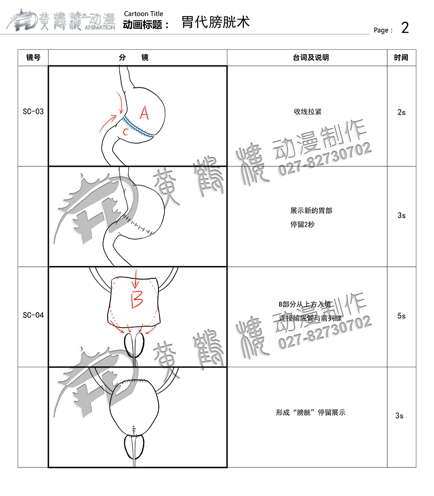 胃代膀胱術(shù)醫(yī)療手術(shù)動(dòng)畫制作2.jpg
