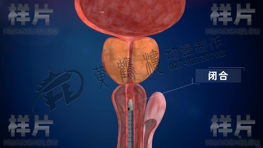醫(yī)療器械產(chǎn)品動畫制作.jpg 醫(yī)療器械產(chǎn)品動畫制作.jpg