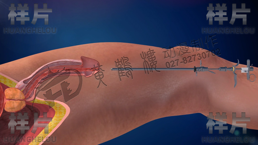 電刀手術(shù).jpg 電刀手術(shù).jpg
