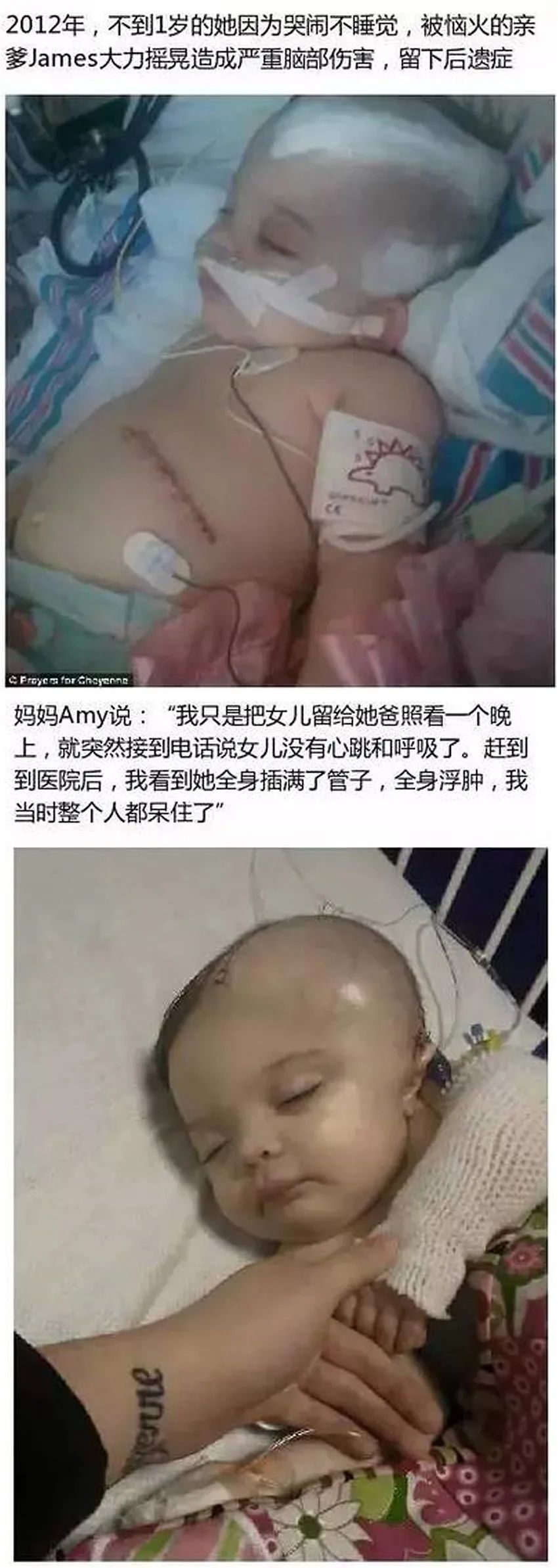 育兒醫(yī)學科普:大力搖晃會損傷寶寶的大腦致腦損傷