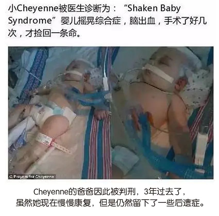 育兒醫(yī)學科普:大力搖晃會損傷寶寶的大腦致腦損傷