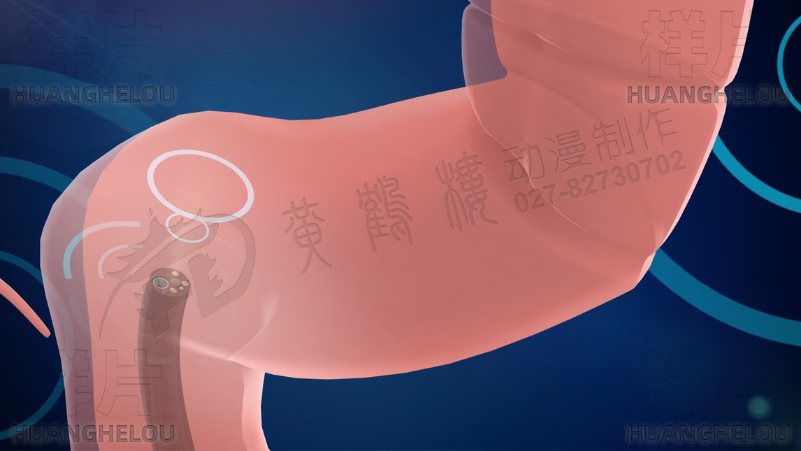 腸鏡由肛門進(jìn)入,通過鏡頭及鏡體磁圈共同作用力牽引前進(jìn).jpg 腸鏡由肛門進(jìn)入,通過鏡頭及鏡體磁圈共同作用力牽引前進(jìn).jpg